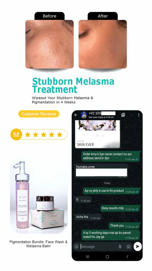 Face Balm For Melasma 50% off & free delivery